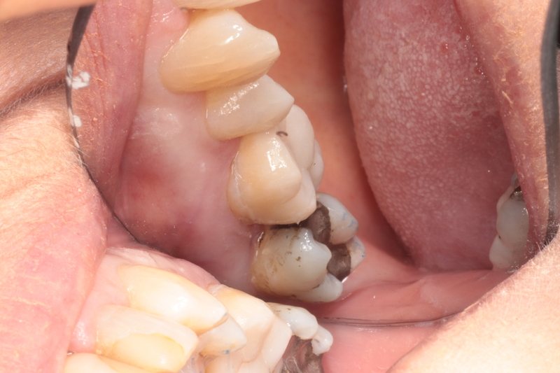 After — lateral view of ceramic onlay