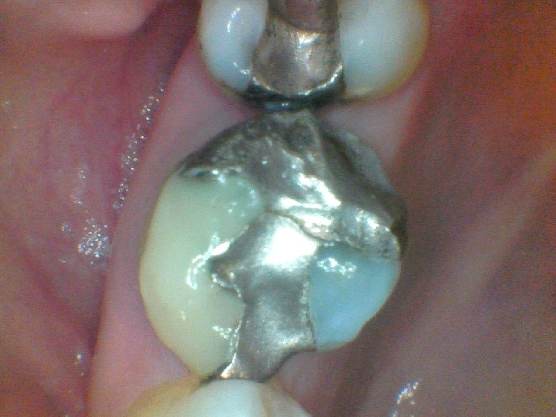 Before — fractured amalgam filling