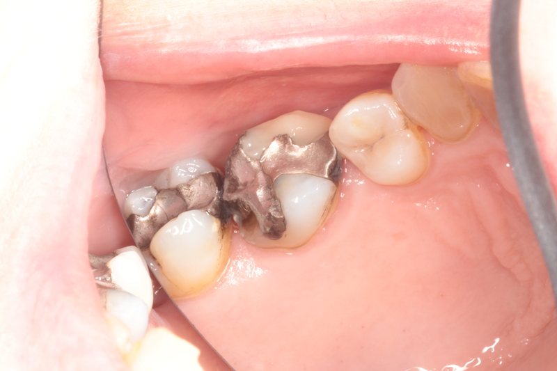 Before — second view of amalgam fillings