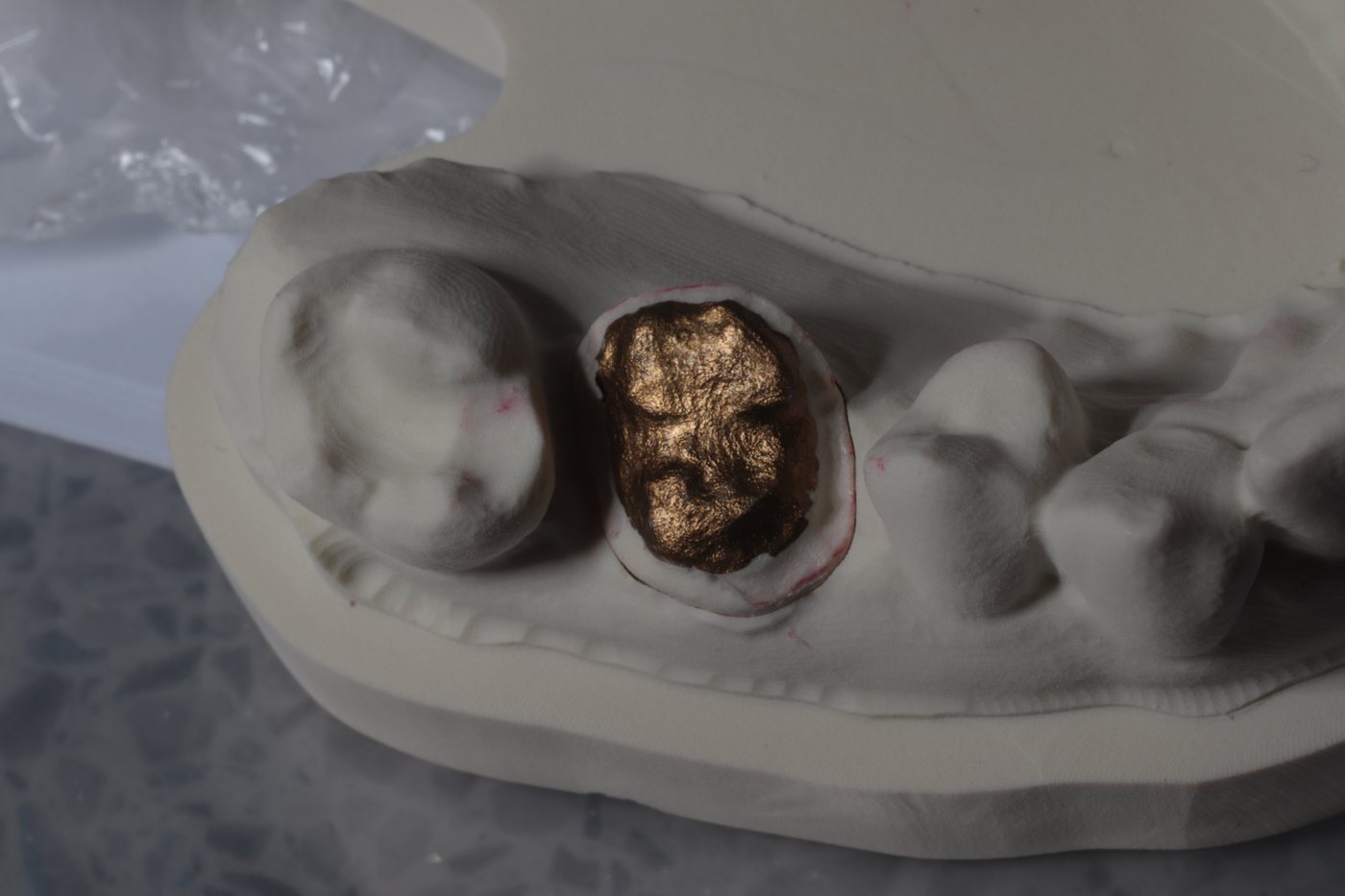 Study model with gold replica onlay