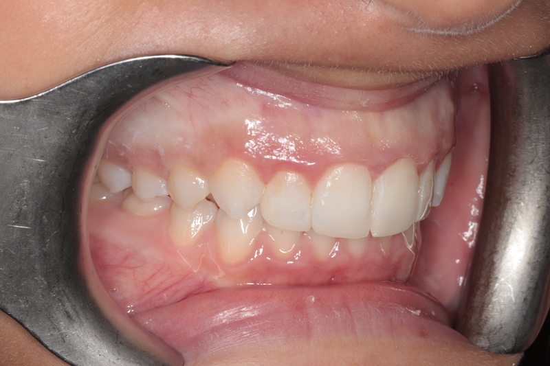 After Invisalign + whitening + composite veneers
