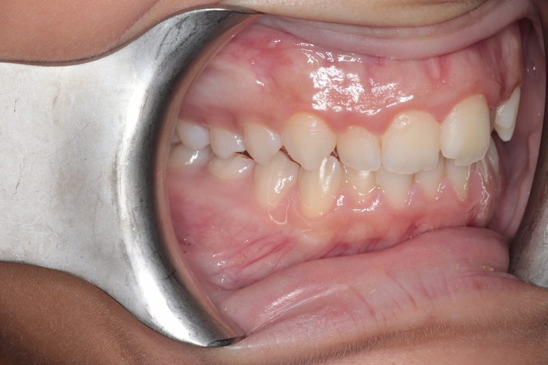 Before Invisalign + whitening + composite veneers