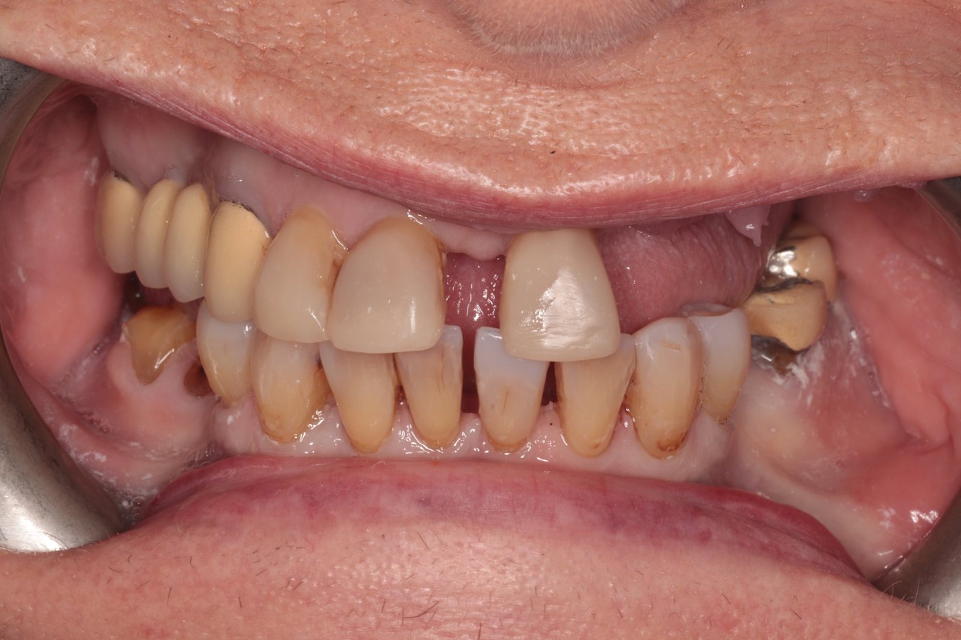 After composite bonding stage