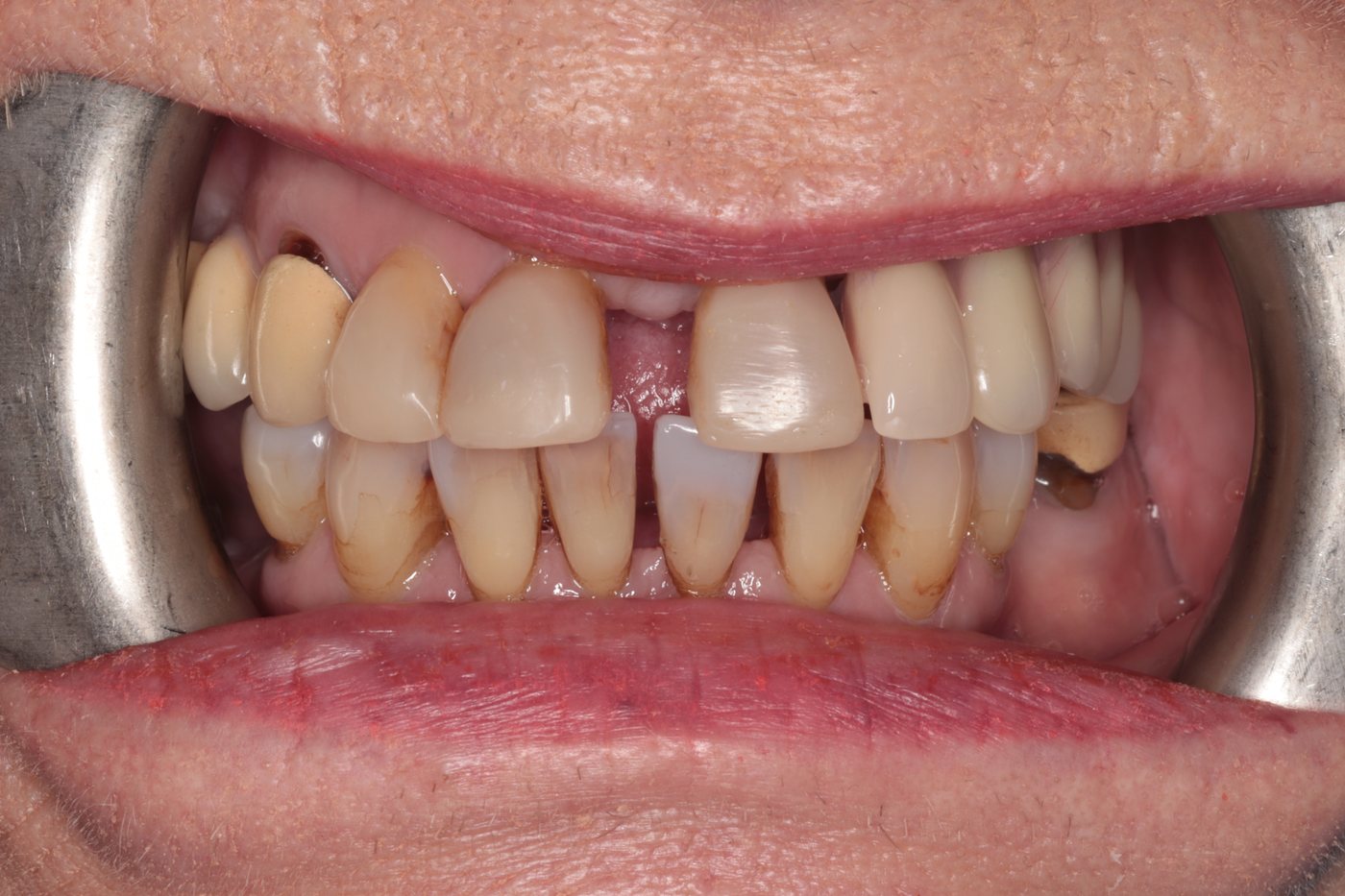 After — with partial chrome dentures