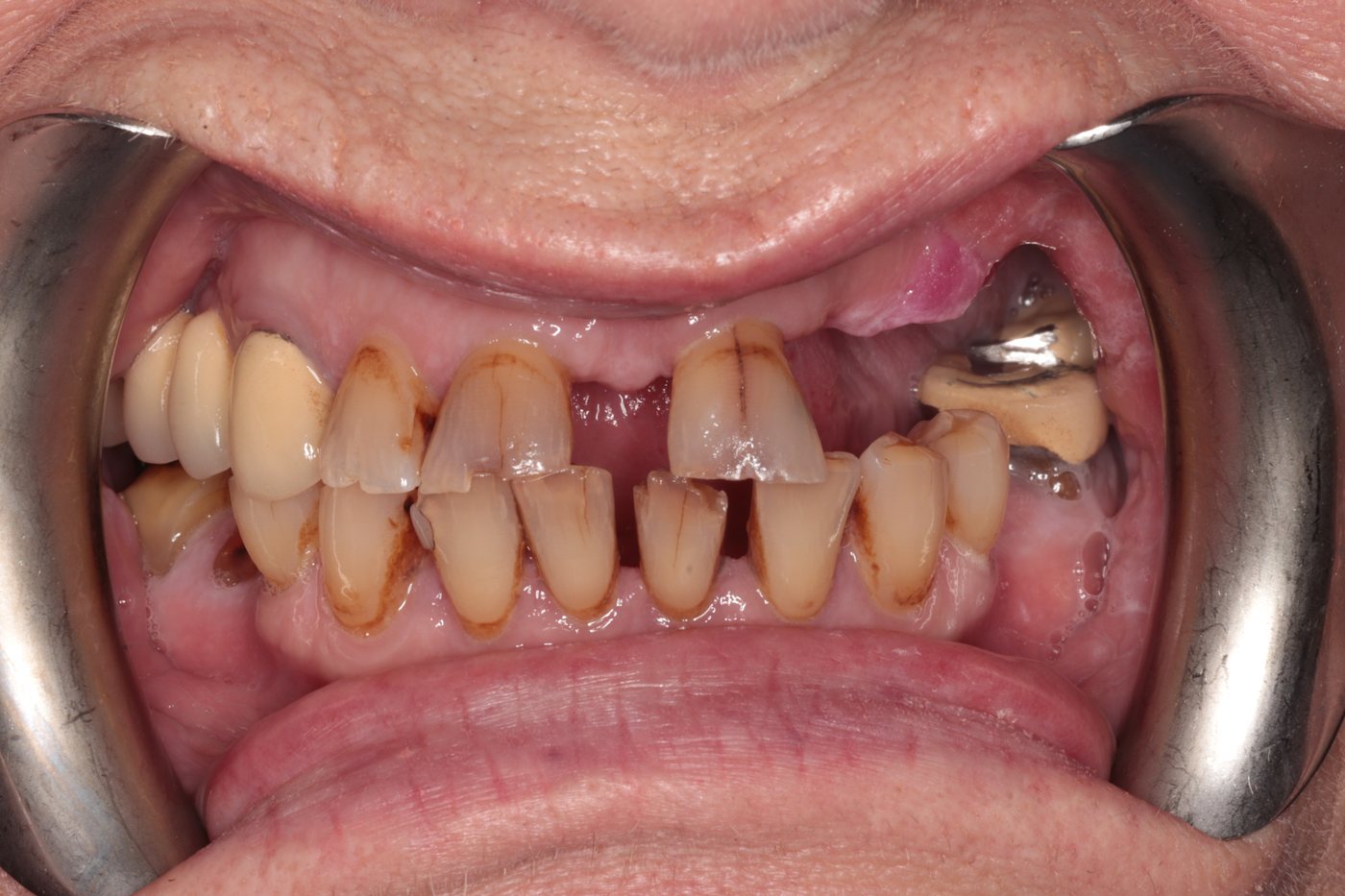 Before — composite bonding and partial chrome dentures case