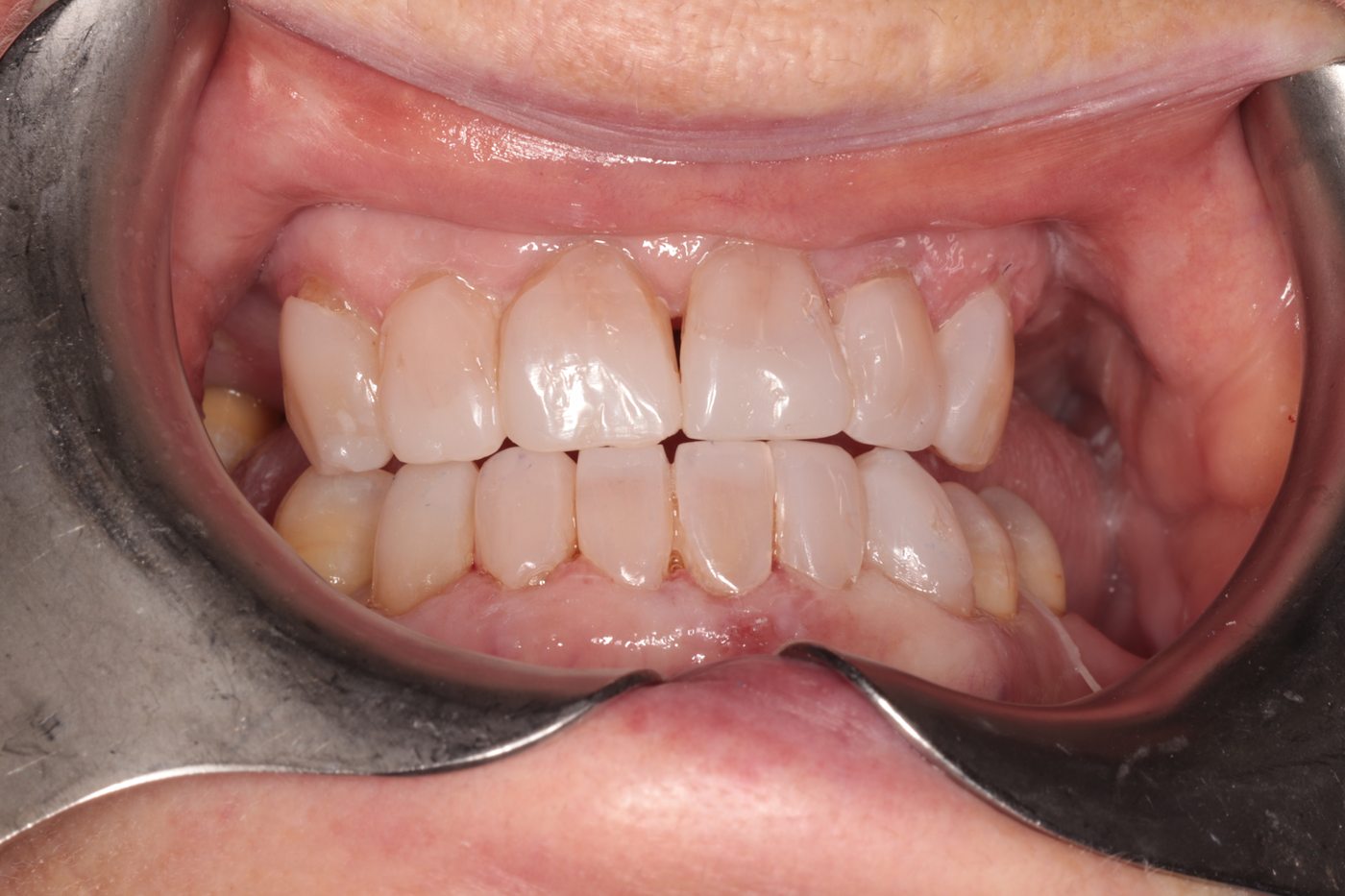 After full smile makeover treatment