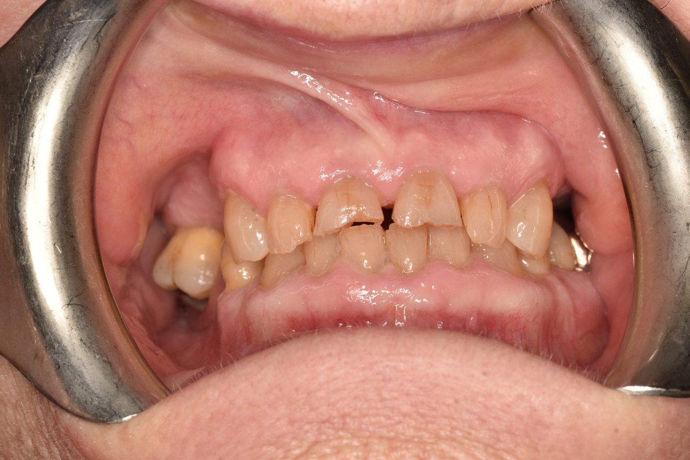 Before full smile makeover treatment
