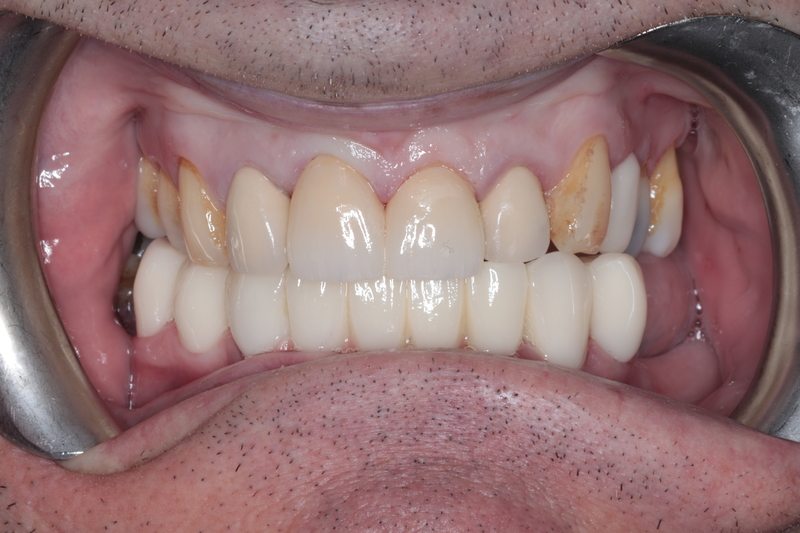 After Two ceramic crowns