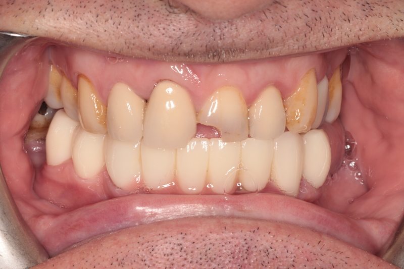 Before Two ceramic crowns