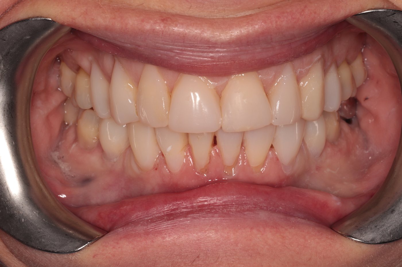 After composite bonding for tooth wear — retracted view