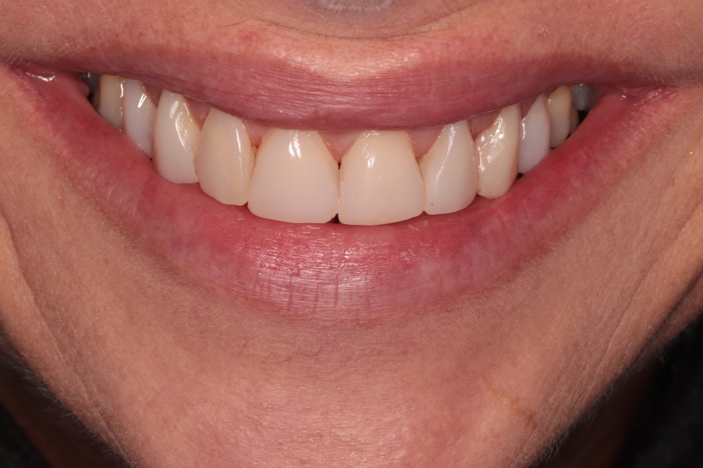 After composite bonding for tooth wear — smile view