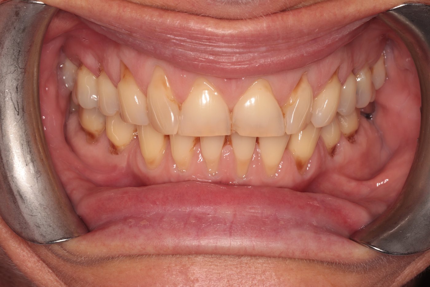 Before composite bonding for tooth wear — retracted view
