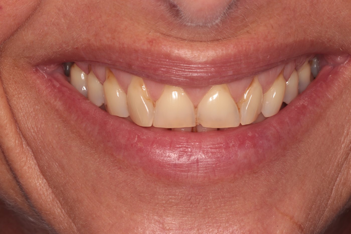 Before composite bonding for tooth wear — smile view